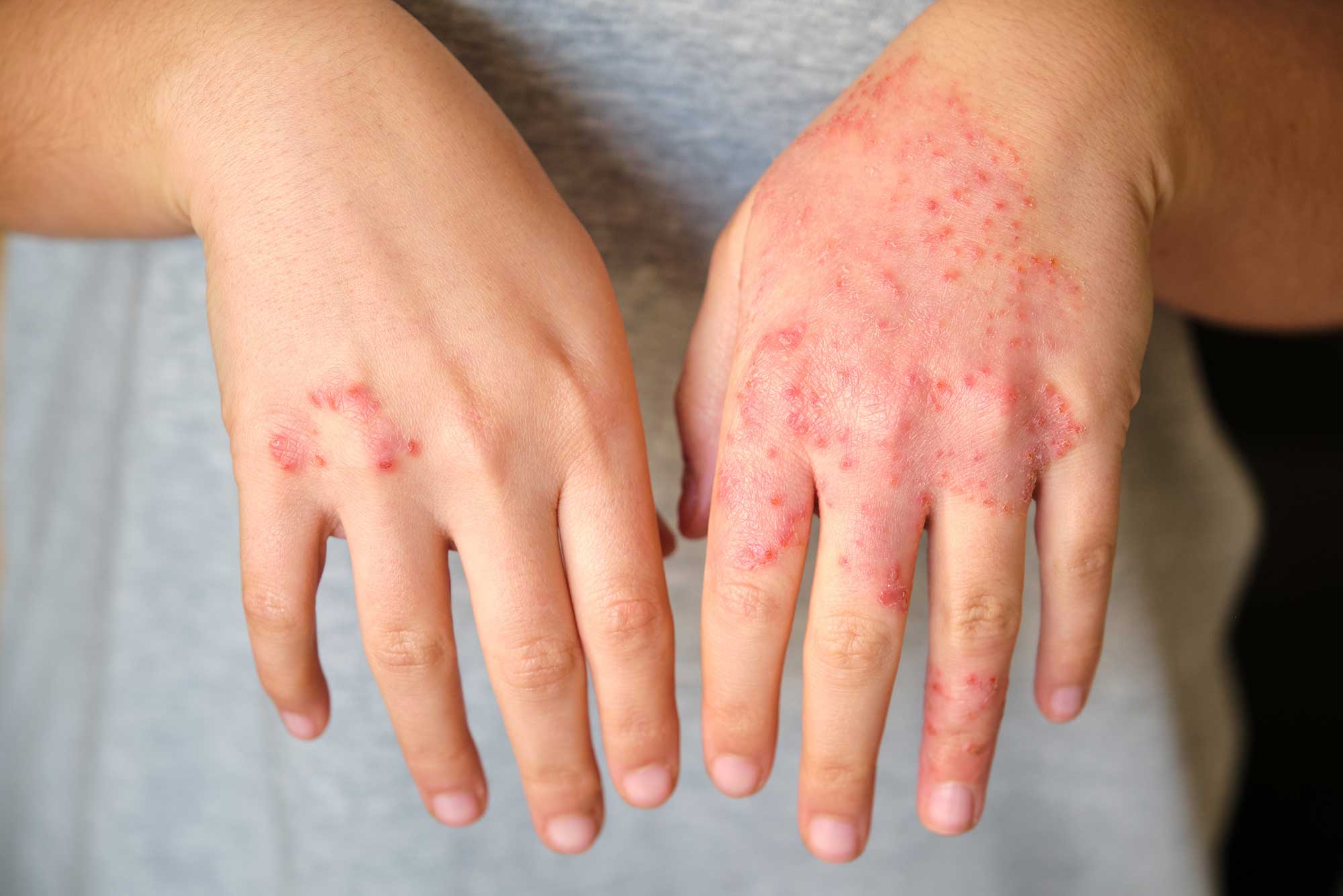 Psoriasis-Arthritis fr�h erkennen